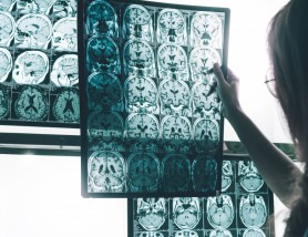 Legatura dintre Alzheimer si igiena orala